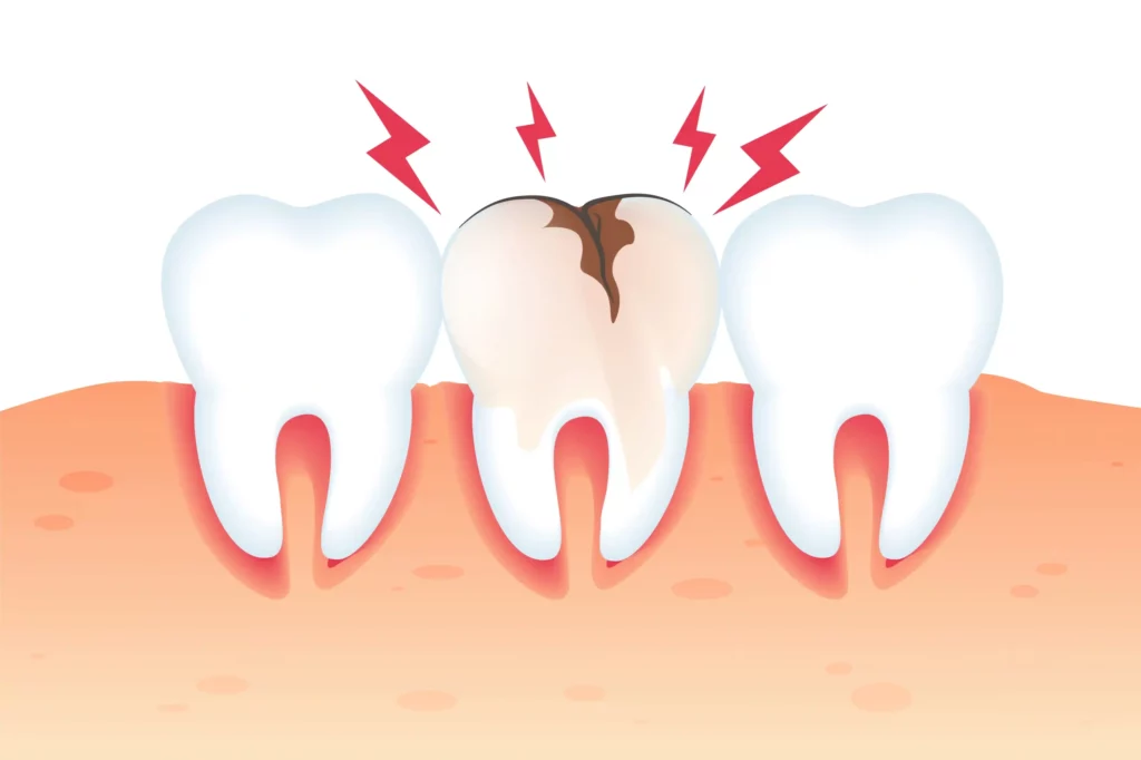 Dental decay